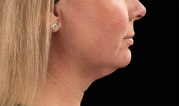 double chin reduction treatment coolsculpting Bernardsville